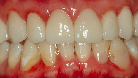 After: porcelain crowns