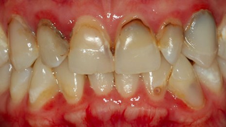 Before: discoloured fillings