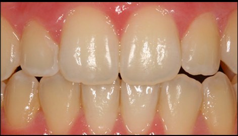 After: orthodontic treatment
