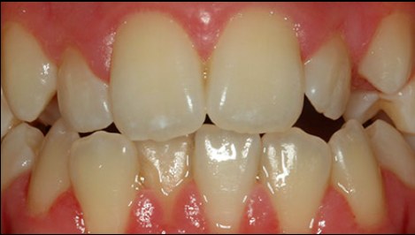 Before: misaligned, crowded teeth