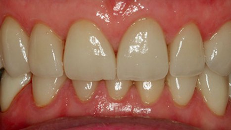 After: porcelain veneers