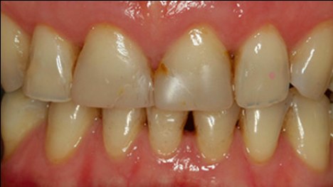 Before: discoloured fillings